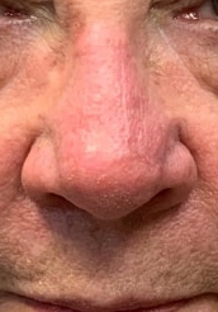 Nasal reconstruction