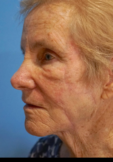 Cheek Reconstruction