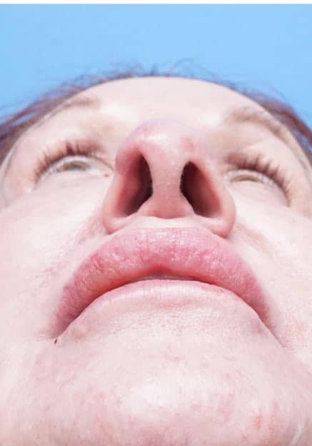 Nasal Reconstruction