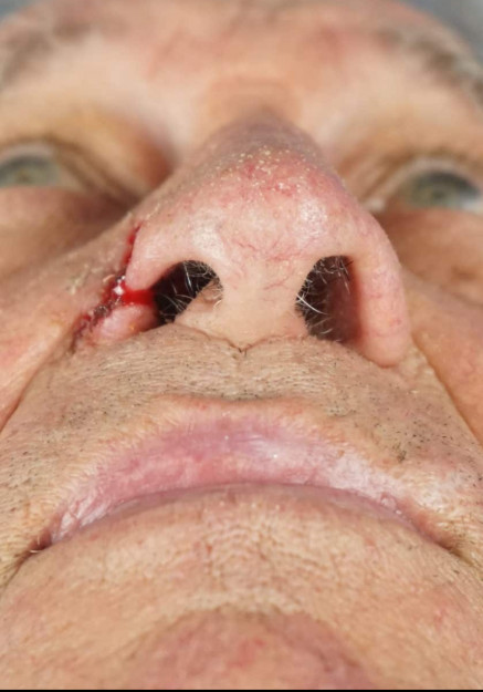 Nasal Reconstruction