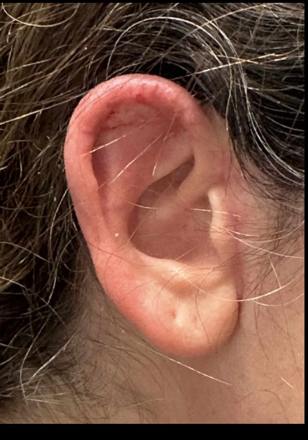 Ear Reconstruction