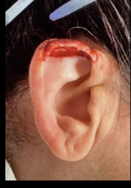 Ear Reconstruction