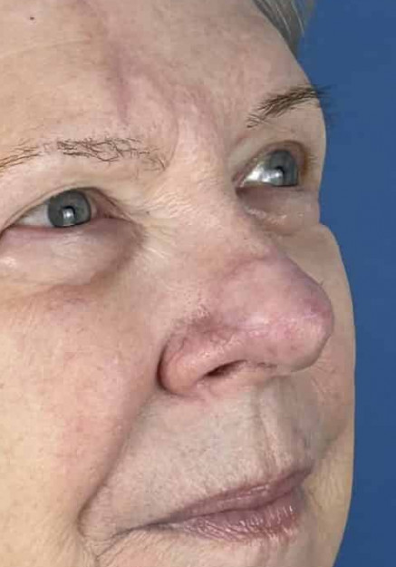 Nasal Reconstruction