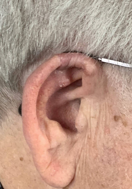 Ear Reconstruction