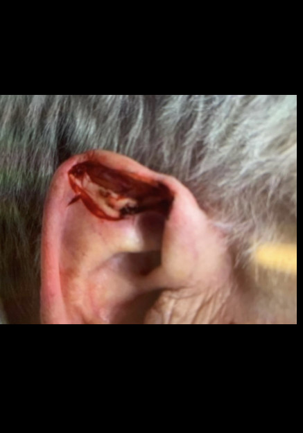 Ear Reconstruction