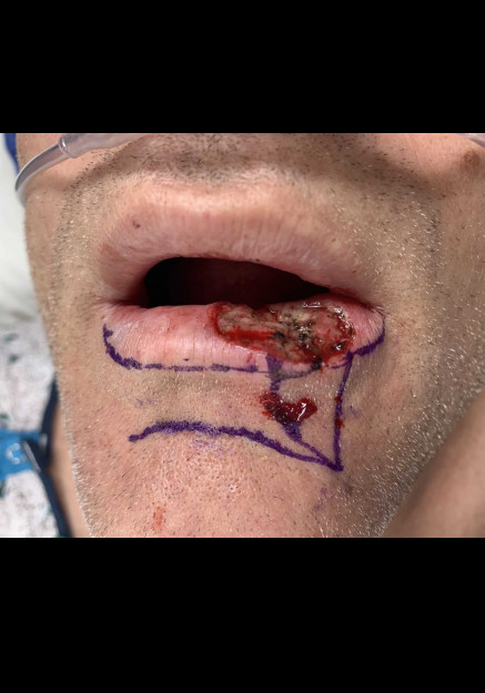 Lip Reconstruction