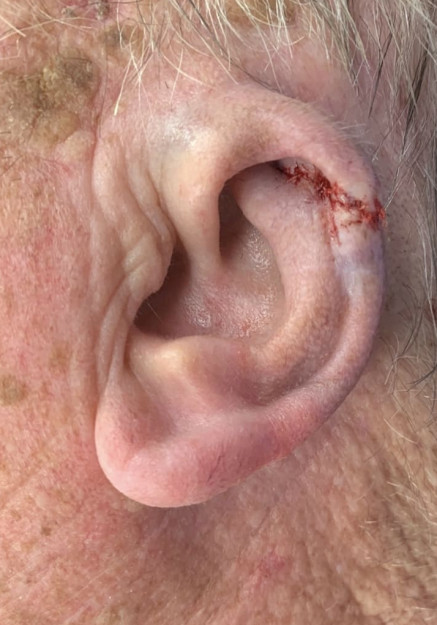 Ear Reconstruction