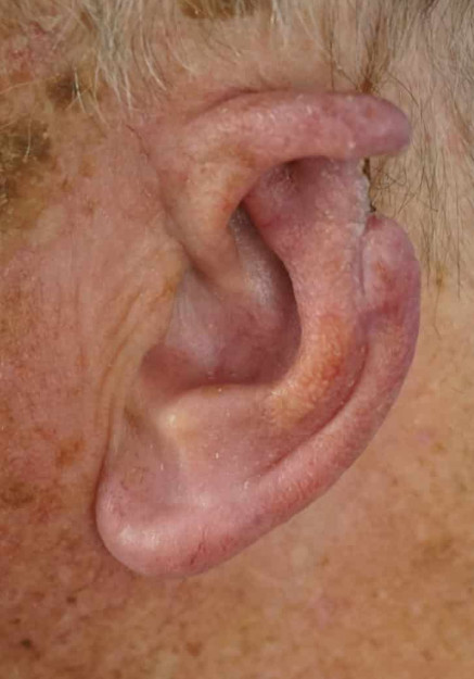 Ear Reconstruction